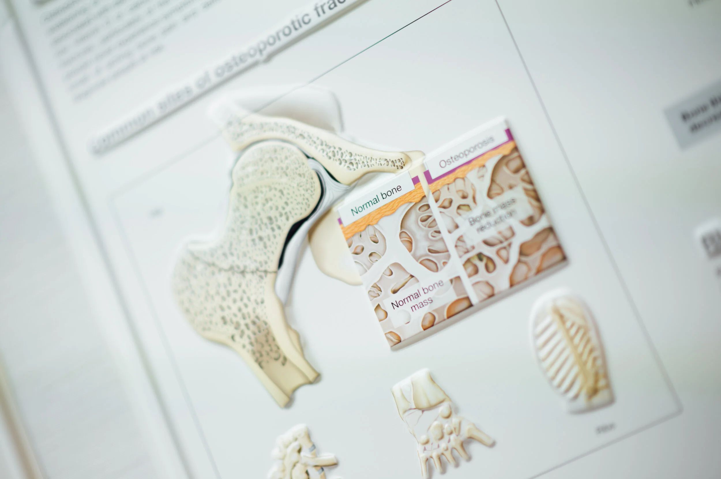 Anatomical display comparing healthy bone with osteoporotic bone and common osteoporotic fracture sites.
