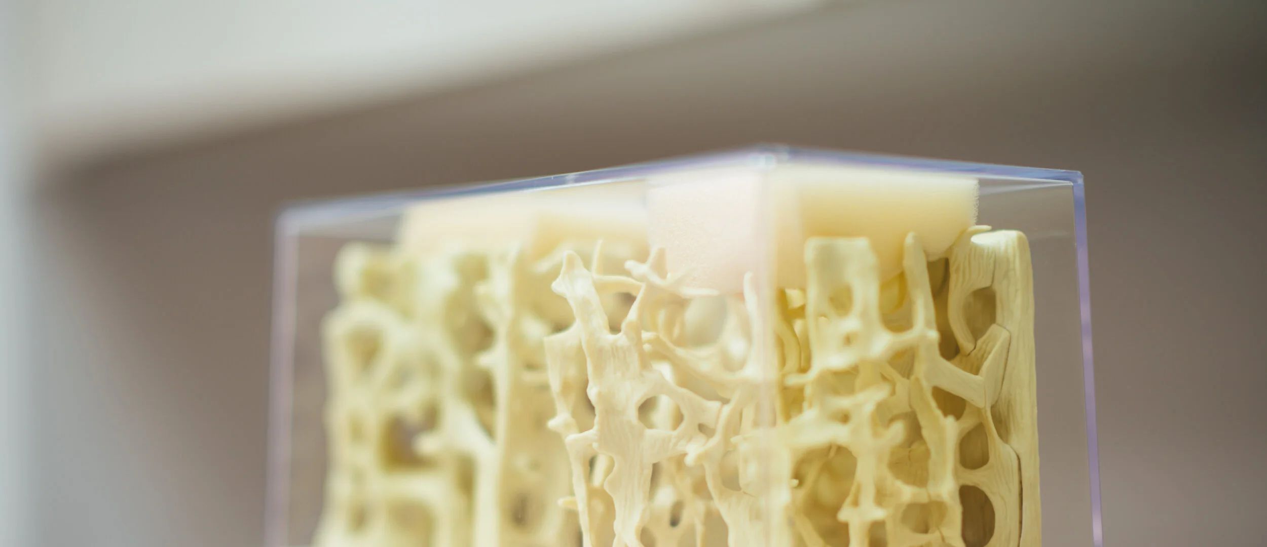 Model of trabecular (spongy) bone microarchitecture in a display case.